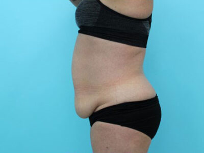 Abdominoplasty