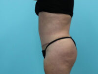 Abdominoplasty