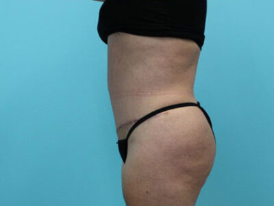Abdominoplasty