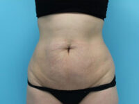 Abdominoplasty