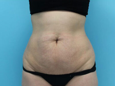 Abdominoplasty