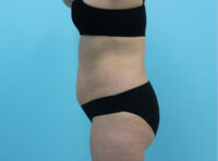 Abdominoplasty