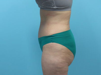 Abdominoplasty