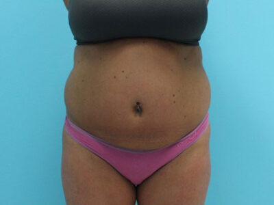 Abdominoplasty