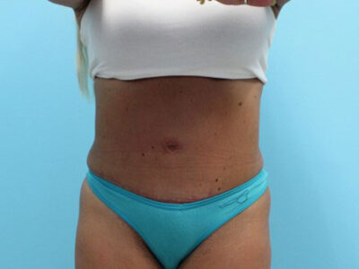 Abdominoplasty