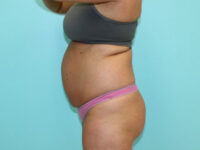 Abdominoplasty