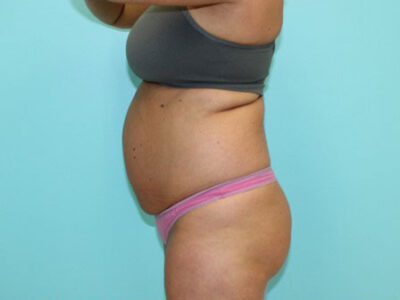 Abdominoplasty