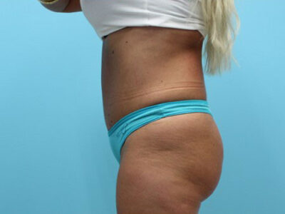 Abdominoplasty