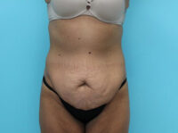 Abdominoplasty
