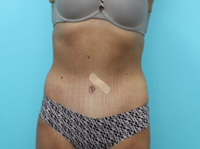 Abdominoplasty