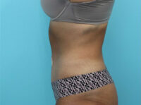 Abdominoplasty