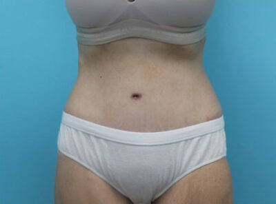 Abdominoplasty