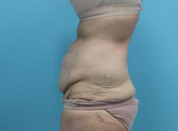 Abdominoplasty