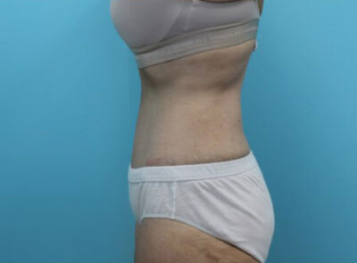 Abdominoplasty