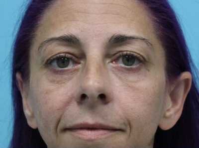 Blepharoplasty