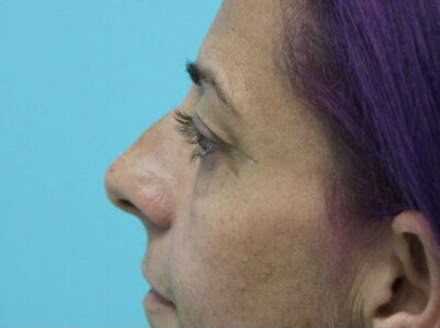 Blepharoplasty