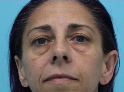 Blepharoplasty