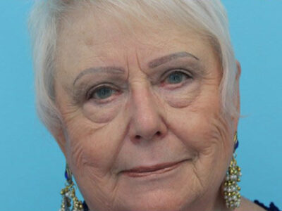 Blepharoplasty