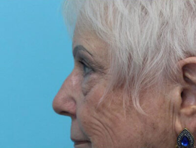 Blepharoplasty