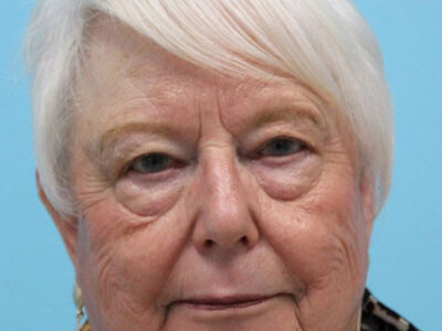 Blepharoplasty