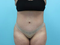 Abdominoplasty