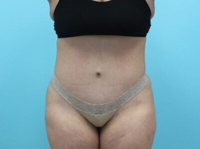 Abdominoplasty
