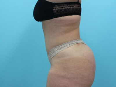Abdominoplasty