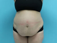 Abdominoplasty