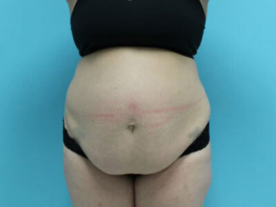Abdominoplasty