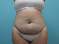 Abdominoplasty