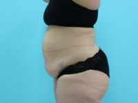 Abdominoplasty