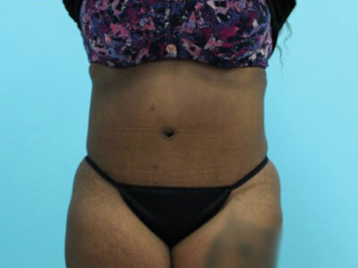Abdominoplasty
