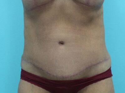 Abdominoplasty