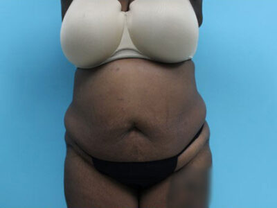 Abdominoplasty