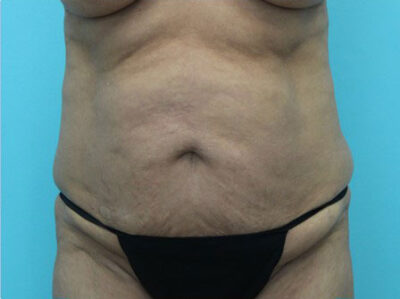 Abdominoplasty
