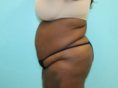 Abdominoplasty