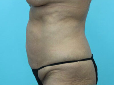 Abdominoplasty
