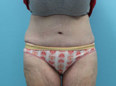Abdominoplasty