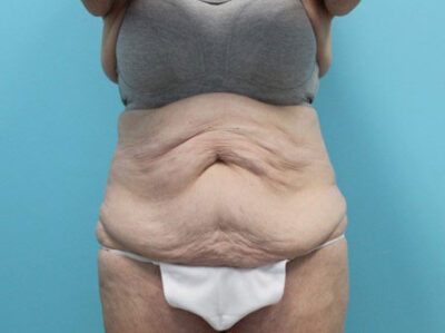 Abdominoplasty