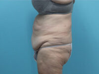 Abdominoplasty