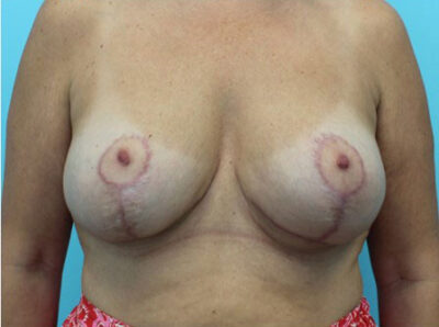 Augmentation & Mastopexy