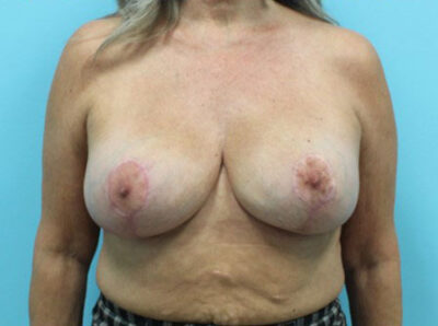 Augmentation & Mastopexy