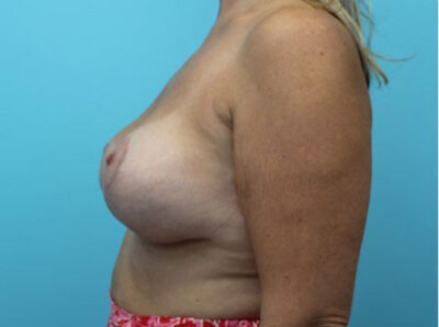 Augmentation & Mastopexy