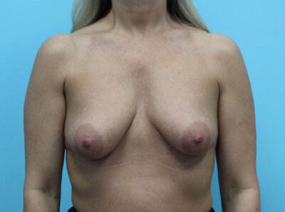 Augmentation & Mastopexy