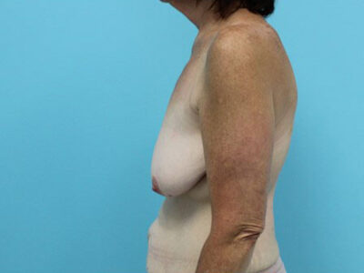 Augmentation & Mastopexy