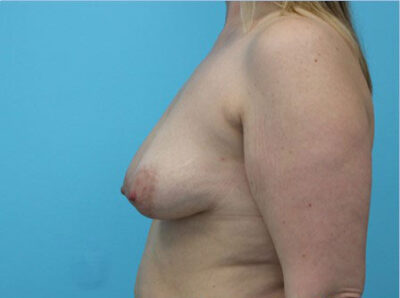 Augmentation & Mastopexy