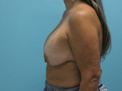 Augmentation & Mastopexy