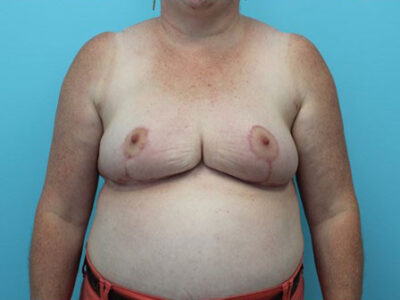 Breast Reduction