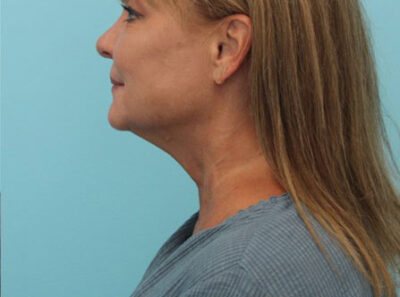 Necklift