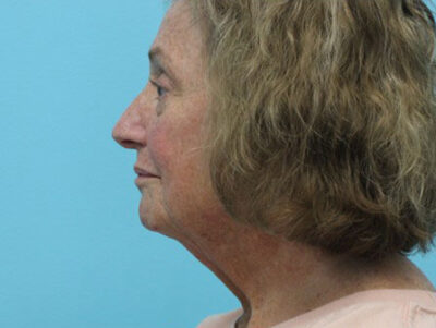 Blepharoplasty
